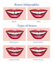 Teeth don't look as attractive when they're covered with metal, ceramic or acrylic overlays, whether they're almost invisible or designed to match the color of our teeth. Free Teeth Braces Vectors 200 Images In Ai Eps Format