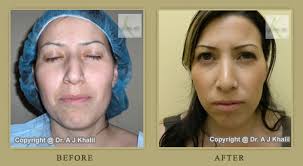 Rhinoplasty Gallery