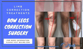 Bowed Leg Syndrome Leg Curvature Correctional Therapies Bow Legged Bow Legged Correction Legs