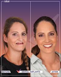 Transforming Smiles, Transforming Confidence! ✨ We're excited to share the  incredible smile journey of our dear patient Milena Boyanova Ralcheva ❤️  Her beautiful transformation reflects trust, care, and the expertise we  proudly