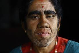 But researchers knew the disorder runs in families, and in 1995 they. 25 Incredible Images Of A Family Living With Werewolf Syndrome