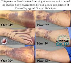 Luckily, you can recover from a hamstring injury if you allow yourself proper rest, treat your injury, and give yourself time to. Large Bruise Drained Quickly By Kinesio Tape Harmony Chiropractic Toledo