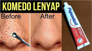 Cara Mengatasi Komedo Secara Alami Hanya Menggunakan Pasta Gigi Gerai Sehat Youtube