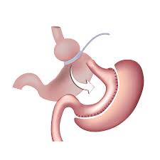 See more ideas about bariatric, bariatric eating, bariatric recipes. Bariatric Revision Surgery Plano Tx Texas Center For Bariatrics Advanced Surgery