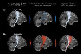 Image result for Thalamotomy