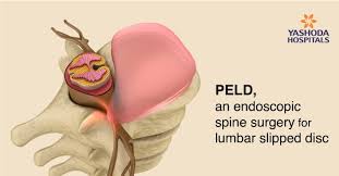 A herniated disc at l5/s1 is an extremely common problem. How To Diagnose And Treat Herniated Disc Peld