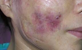 عکس قبل و بعد لاغری صورت+عکس تزریق چربی به صورت بعد از یک ماه