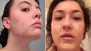 As dermatologist debra jaliman explained to allure, these bandages dry out pimples without drying the skin around it, effectively shrinking and draining the pimple until it's gone. Do Hydrocolloid Bandages For Acne Work We Investigate Glamour