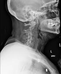 Here's what to expect with this painless procedure and why your dentist may recommend it. Cervical Spine Imaging In Trauma