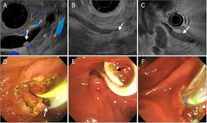 Image result for Choledocholithiasis