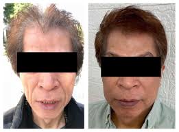 Novel modalities for hair growth & skin repair