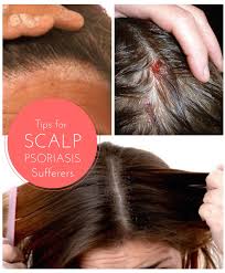 Tips For Finding Effective Relief From The Symptoms Of Scalp Psoriasis Mlcoco Scalppso Psoriasis Remedies Scalp Itchy Scalp Remedy Scalp Psoriasis Treatment