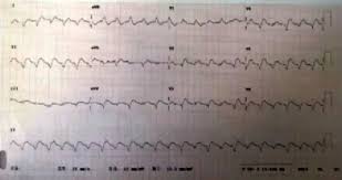The site owner hides the web page description. æš´ç™¼æ€§å¿ƒè‚Œç‚Žçš„è¨ºç™‚é›·å€ ä½ è¸©äº†å—Ž