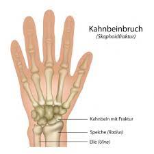 Kahnbeinbruch Ursachen Symptome Behandlung Medlexi De