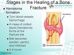 Fractures And Bone Healing Page 1 Of 39