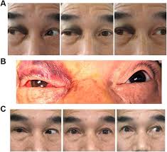 Medial Rectus Anastomosis Under Endoscopic Endonasal Orbital Approach With  Image-Guided Navigation: A New Way of Repairing a Ruptured Medial Rectus