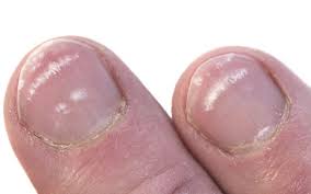 Nagelverfarbungen Ursachen Behandlung Onmeda De