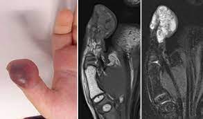 Venöse thrombosen betreffen vor allem die beinvenen, wobei man nach der lokalisation eine oberflächliche form der thrombose (thrombophlebitis) von der tiefen venenthrombose (phlebothrombose) unterscheidet. Compgefa Thrombophlebitis