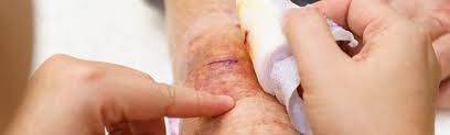 Sepsis, often called blood poisoning, is a medical emergency. Wounds Infection Sepsis End In Sight Healthcap Usa