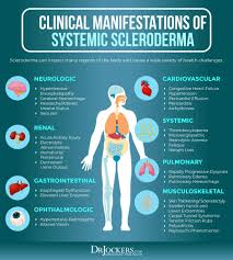 Image result for Systemic Sclerosis