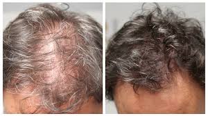 When hair follicles are damaged or irritated, it can cause itching or tingling, as well as areas of hair thinning. Women S Hair Loss Scalp Micropigmentation For Women By Hairline Ink Hairline Ink