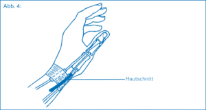 Tendovaginitis De Quervain Freiburg Chirurgie Im Stuhlinger
