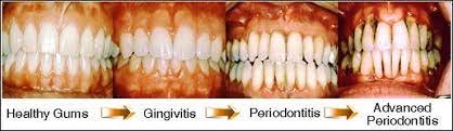 An understanding of the nature and pathogenesis of these are found more frequently in the maxilla than in mandible. How To Reverse Periodontal Disease Without Surgery Peter Galgut