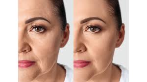 Turning Back the Clock with a Facelift