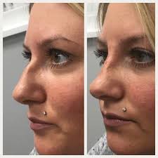 Hope you have a solution, as i'm feeling insecure to contour your nose, start by using a small brush and some bronzer to draw contour lines from your brow bone to the bottom of your nose. Liquid Nose Job Nose Job Nose Makeup Tips