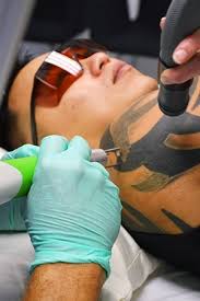 Let's quickly remind ourselves exactly what a tattoo is: 7 Most Frequently Asked Questions From Tattoo Removal Patients