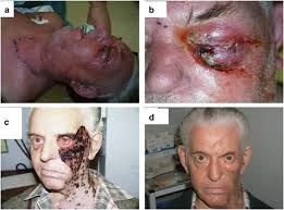 State contractor hired to help children pleads to theft from program former da was ready to indict, arrest gang members last year, sheriff was not here's how much you have to make to afford rent in augusta, columbia county mike padgett highway crash leaves one dead, richmond county deputy hurt mayor davis discusses the impact of the bipartisan infrastructure bill Multidisciplinary Management Of Periocular Necrotising Fasciitis A Series Of 11 Patients Eye