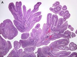 Squamous Cell Carcinoma Of The Oral Cavity And Oropharynx Surgical Pathology Clinics