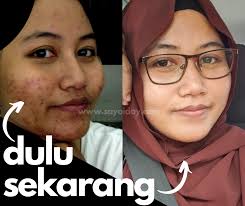 Demikianlah lapan petua hilangkan jerawat yang boleh anda praktikkan bagi mengatasi dan mencegah masalah jerawat. Cara Menghilangkan Jerawat Breakout Teruk Akibat Salah Pakai Produk