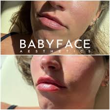 Nothing like a fresh lip💉🤍 #lips #lip #lipfiller #filler #hyaluronicacid  #fillers #longislandaesthetics #aesthetics #babyface #beforeandafter  #naturallips #natural #naturalresults #nurseinjector #injector #aesthetics