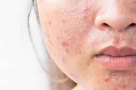 Acne After Stopping Birth Control And How To Heal Your Skin Dr Jolene Brighten