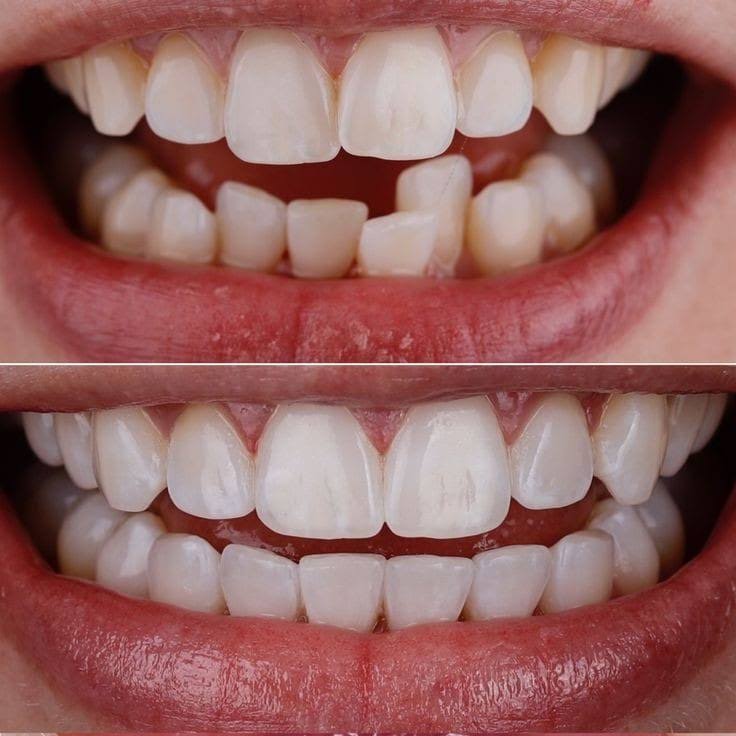 Invisalign product image