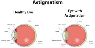 Read about the types of refractive errors, their symptoms and causes, and how they are diagnosed and treated. Astigmatism