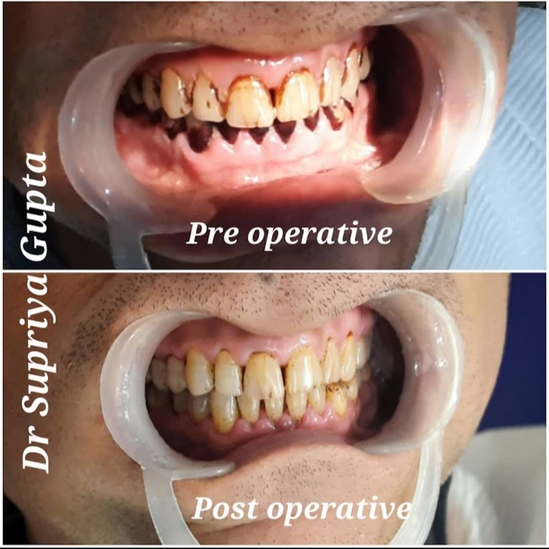 Scaling and Polishing product image