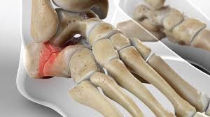 Image result for Calcaneus