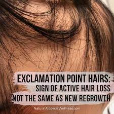 Pin On Alopecia Hair Growth