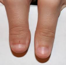 Pastels are not only trendy for a few seasons now. Brachydactyly Type D Wikipedia