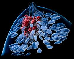 When you're diagnosed with breast cancer, your doctor will give your cancer a grade from 1 to 3 based on how much your cancer cells resemble normal cells. Breast Cancer Metastases Supported By Bone Microenvironment