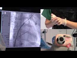 Comme la fibrillation auriculaire favorise la formation de. L Ablation De La Fibrillation Atriale Pr Gabriel Laurent Youtube