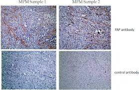 Hematology and oncology (cancer) video. Pdf Chimeric Antigen Receptor Car T Cell Therapy For Malignant Pleural Mesothelioma Mpm Semantic Scholar
