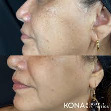 Choosing a Reliable and Safe Provider for Peptide Therapy In the realm of  peptide therapy, ensuring you're in the hands of a safe and reliable  provider is paramount. At Kona Integrative Health,