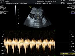 Cara mengetahui hp telah disadap. Pregnancy Journey Dah Tahu Jantina Baby Emilinda