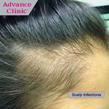 Scalp Infections Ringworm Which Is A Very Common Fungal Scalp Infection Causes Bulk Hair Loss In Patches Hair Loss Reasons Hair Fall Solution Hair Loss But ringworm of the scalp or beard doesn't always make a ring pattern. scalp infections ringworm which is a