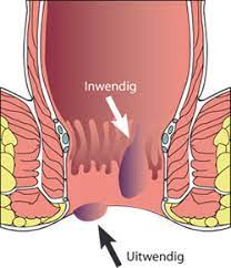 Omdat de meeste aambeien pijnloos zijn, is een mogelijke marker die een aambei heeft trombose plaatselijke aambei medicijnen resulteren meestal niet in verlichting van de pijn van een trombose. Aambeien Symptomen Klachten En Behandeling