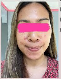 My acne journey has been a long and uncomfortable one. Finding my  confidence after struggling with acne for 10 years is so refreshing and it  feels so good 🥰 wishing this kind