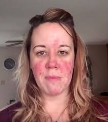 Von Der Couperose Zu Rosacea Hautpflege Bei Geroteter Haut
